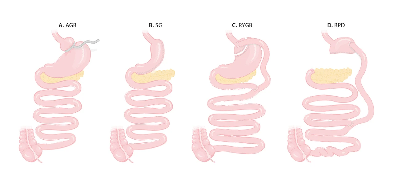 Established Bariatric-Metabolic Surgery procedures