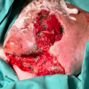 Calcaneal Osteomyelitis Successfully Treated Without Major Amputation before image