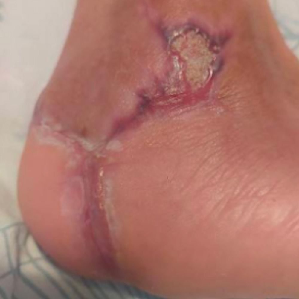 Calcaneal Osteomyelitis Successfully Treated Without Major Amputation procedure image
