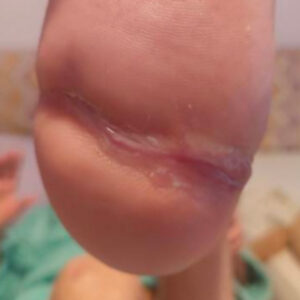 Calcaneal Osteomyelitis Successfully Treated Without Major Amputation outcome image