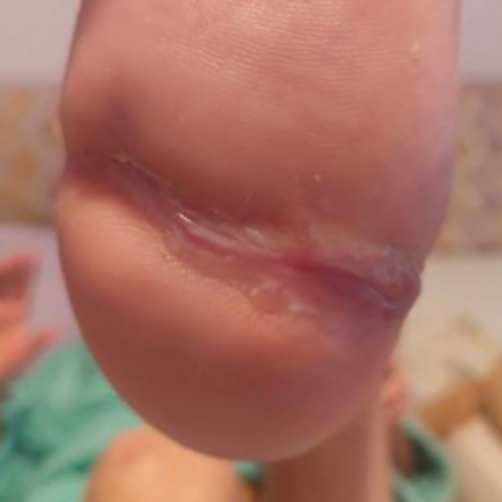Calcaneal Osteomyelitis Successfully Treated Without Major Amputation outcome image