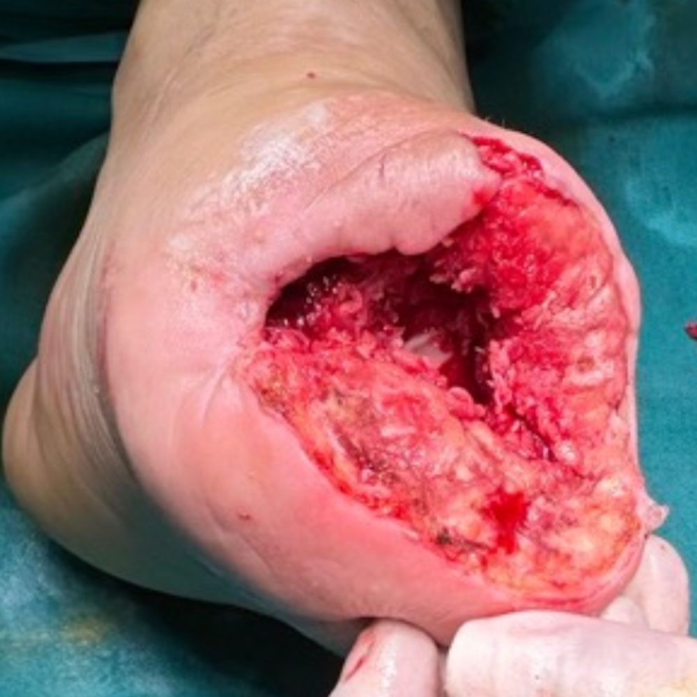 Chopart Amputation Following Successful Revascularization procedure image