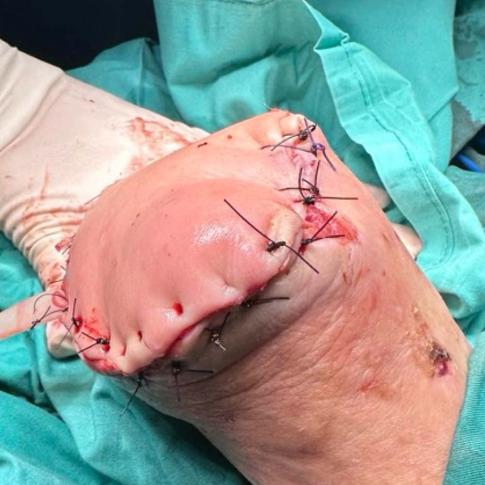 Chopart Amputation Following Successful Revascularization procedure image