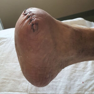 Chopart Amputation Following Successful Revascularization procedure image