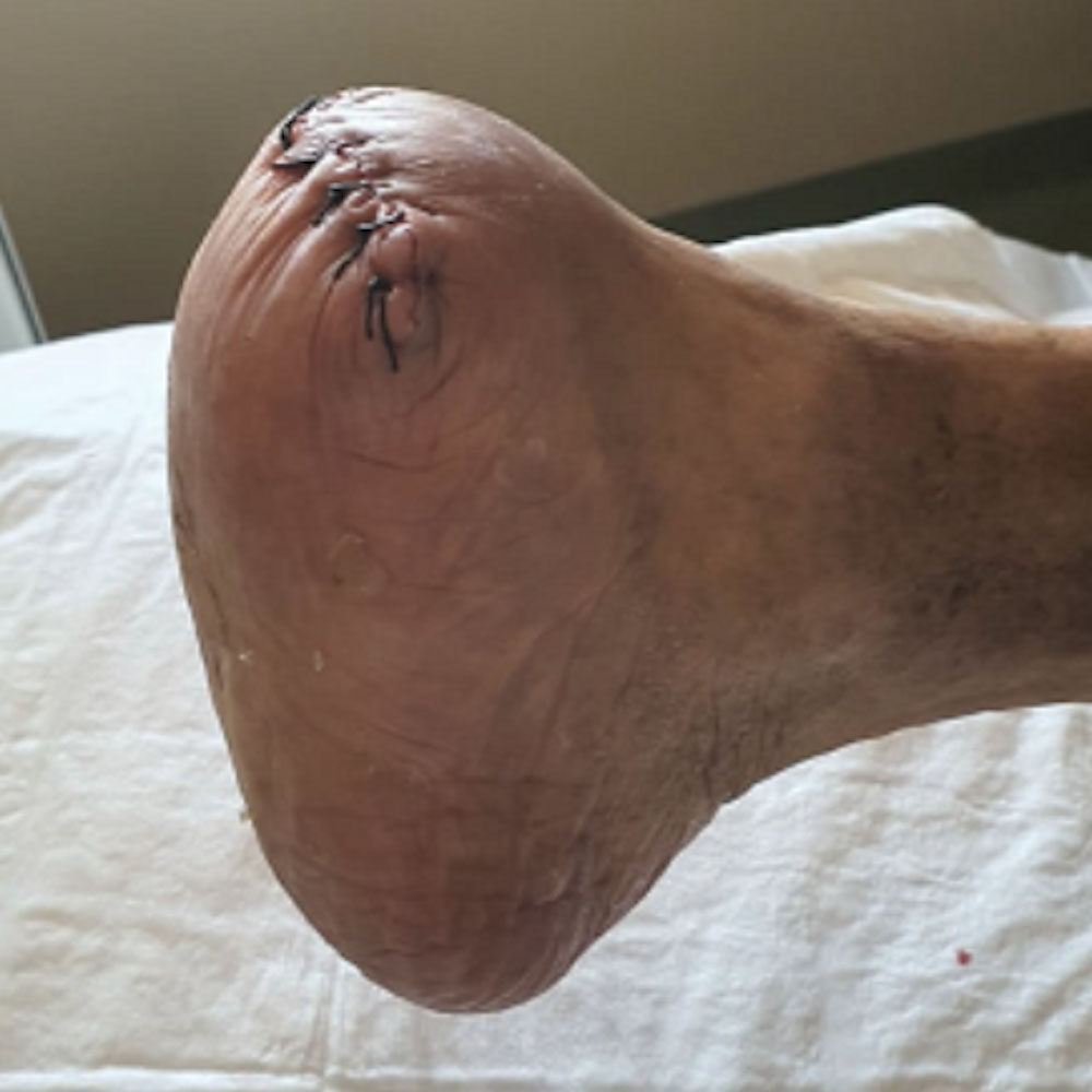 Chopart Amputation Following Successful Revascularization procedure image