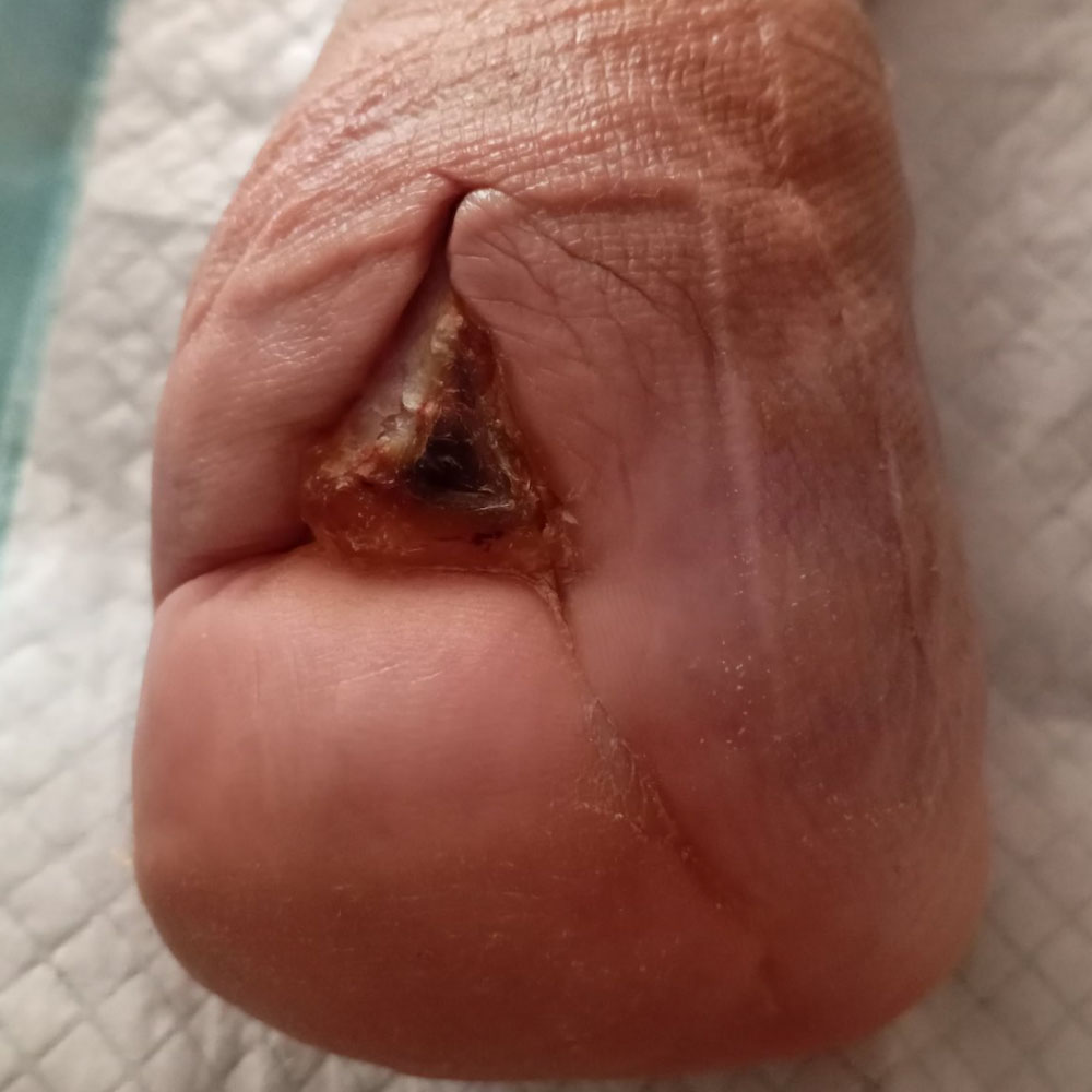 Chopart Amputation Following Successful Revascularization outcome image