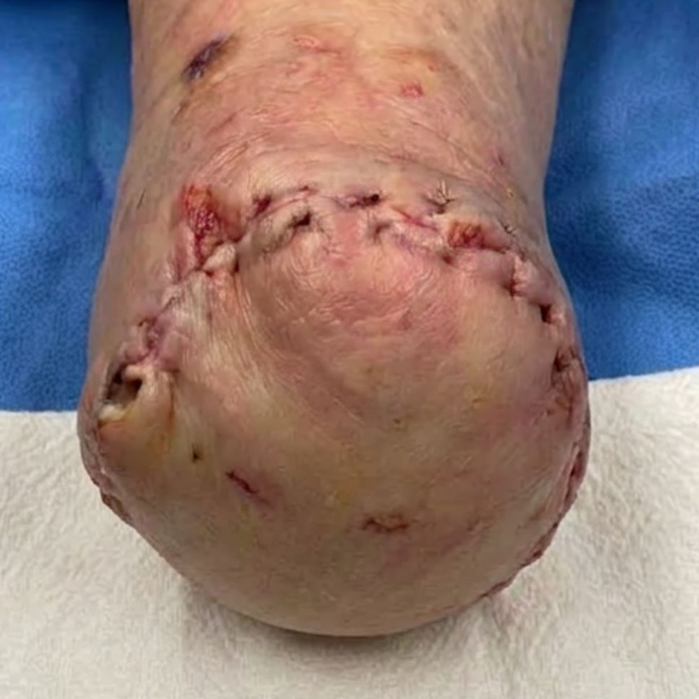 Chopart Amputation Following Successful Revascularization outcome image