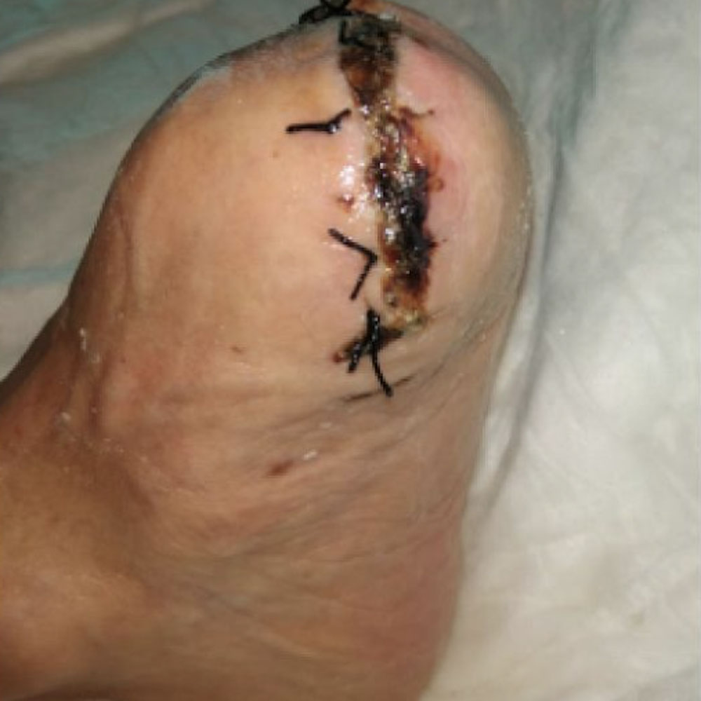 Chopart Amputation Following Successful Revascularization outcome image
