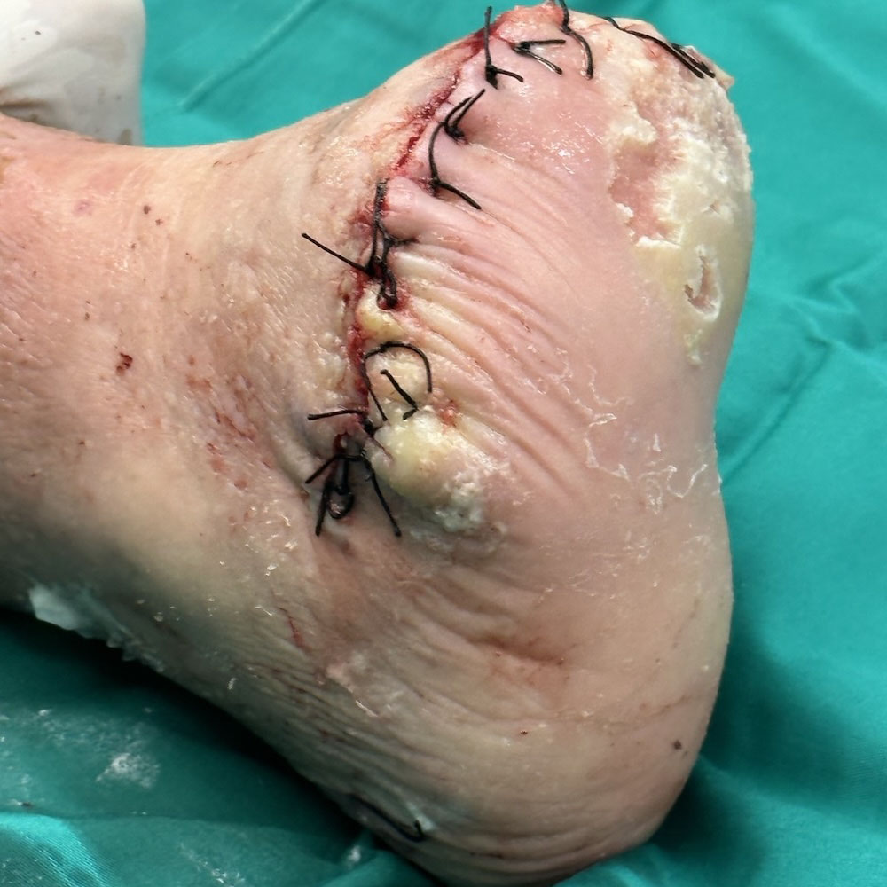Chopart Amputation for Advanced Diabetic Foot Ischemia procedure image