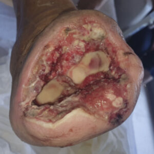 Chopart Amputation for Extensive Midfoot Ischemic Gangrene before image