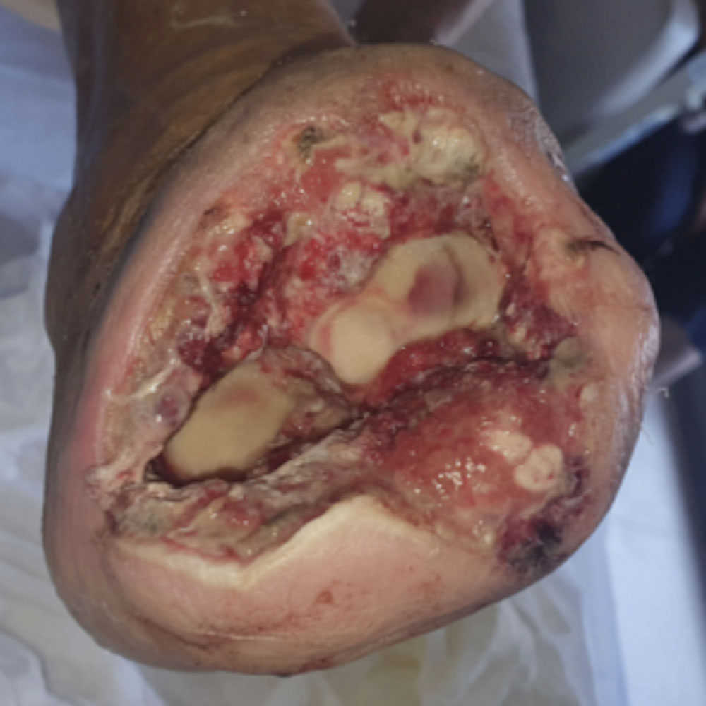Chopart Amputation for Extensive Midfoot Ischemic Gangrene before image