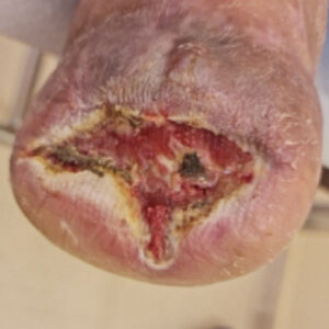 Chopart Amputation for Extensive Midfoot Ischemic Gangrene procedure image