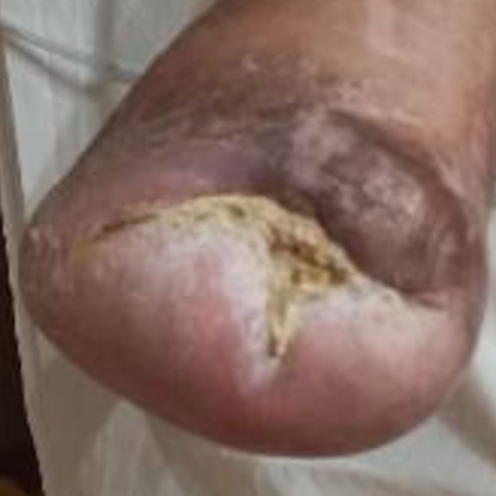 Chopart Amputation for Extensive Midfoot Ischemic Gangrene outcome image