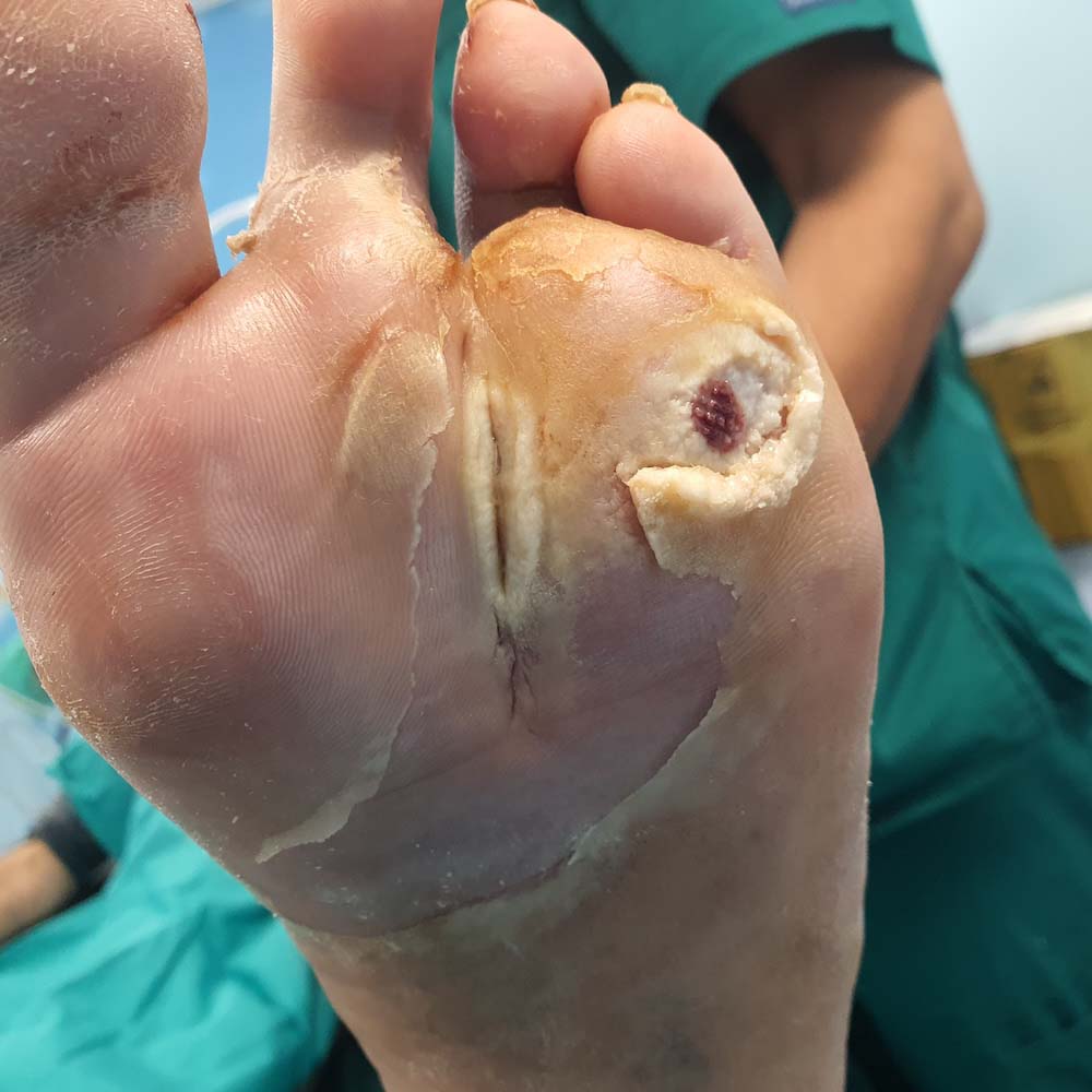 Chronic Plantar Ulcer With Fourth Metatarsal Osteomyelitis before image