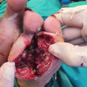 Chronic Plantar Ulcer With Fourth Metatarsal Osteomyelitis procedure image