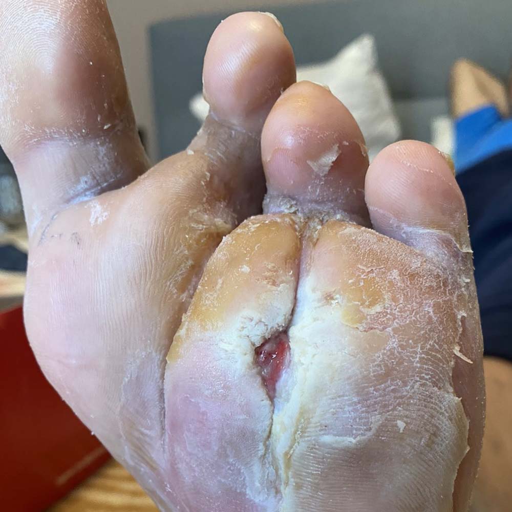 Chronic Plantar Ulcer With Fourth Metatarsal Osteomyelitis outcome image