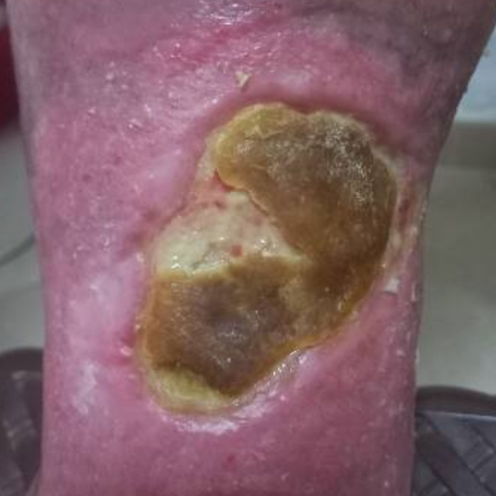 Chronic Venous Leg Ulcer before image
