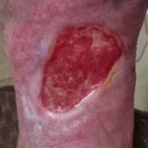 Chronic Venous Leg Ulcer procedure image