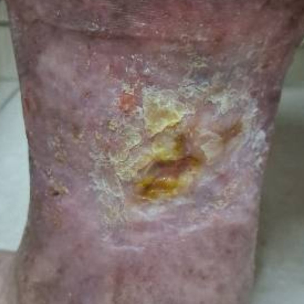 Chronic Venous Leg Ulcer outcome image