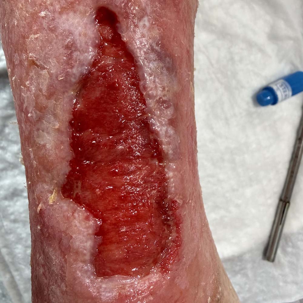 Complex Distal Leg Ulcer before image