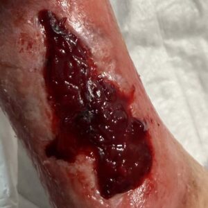 Complex Distal Leg Ulcer procedure image