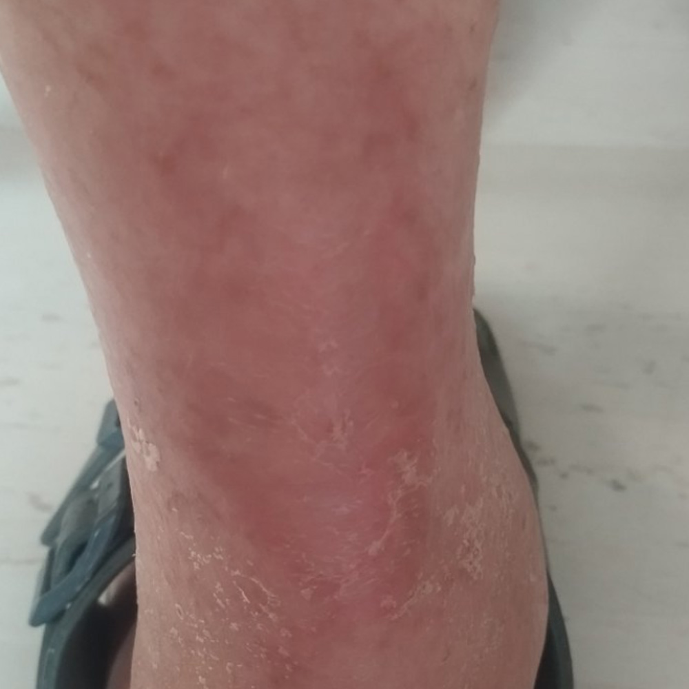 Complex Distal Leg Ulcer outcome image