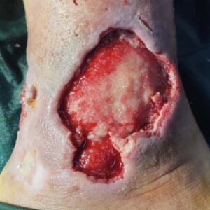 Diabetic Foot Ankle Ulcer Limb Salvage before image