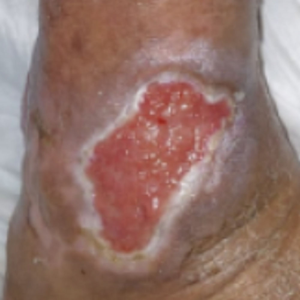Diabetic Foot Ankle Ulcer Limb Salvage procedure image