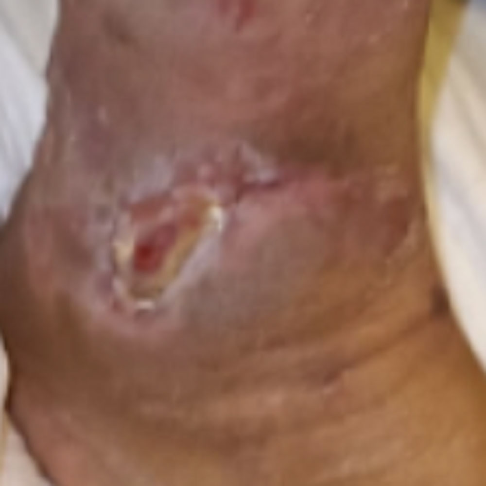 Diabetic Foot Ankle Ulcer Limb Salvage outcome image