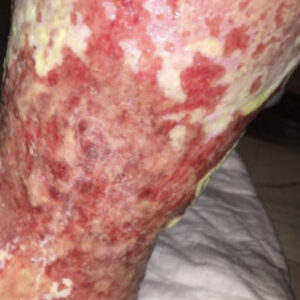 Diabetic Foot Chronic Leg Ulcer with Infection before image