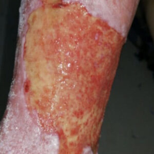 Diabetic Foot Chronic Leg Ulcer with Infection procedure image