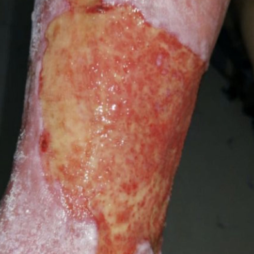 Diabetic Foot Chronic Leg Ulcer with Infection procedure image