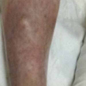Diabetic Foot Chronic Leg Ulcer with Infection outcome image