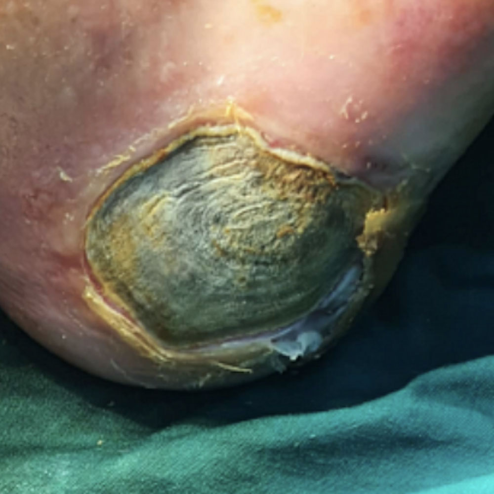 Diabetic Foot Heel Ulcer After Revascularization before image