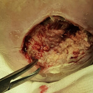 Diabetic Foot Heel Ulcer After Revascularization procedure image