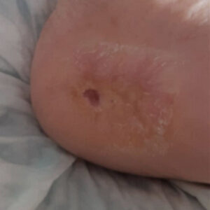 Diabetic Foot Heel Ulcer After Revascularization outcome image