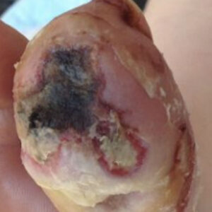 Diabetic Foot Infected Toe Gangrene Without Bone Resection before image