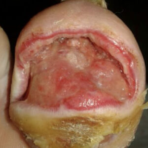 Diabetic Foot Infected Toe Gangrene Without Bone Resection procedure image
