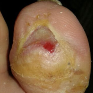 Diabetic Foot Infected Toe Gangrene Without Bone Resection outcome image