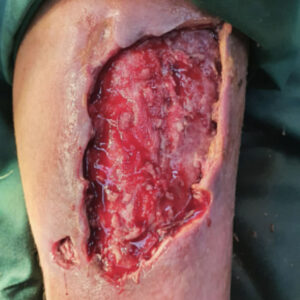 Diabetic Foot Leg Ulcer in a Hemodialysis Patient before image