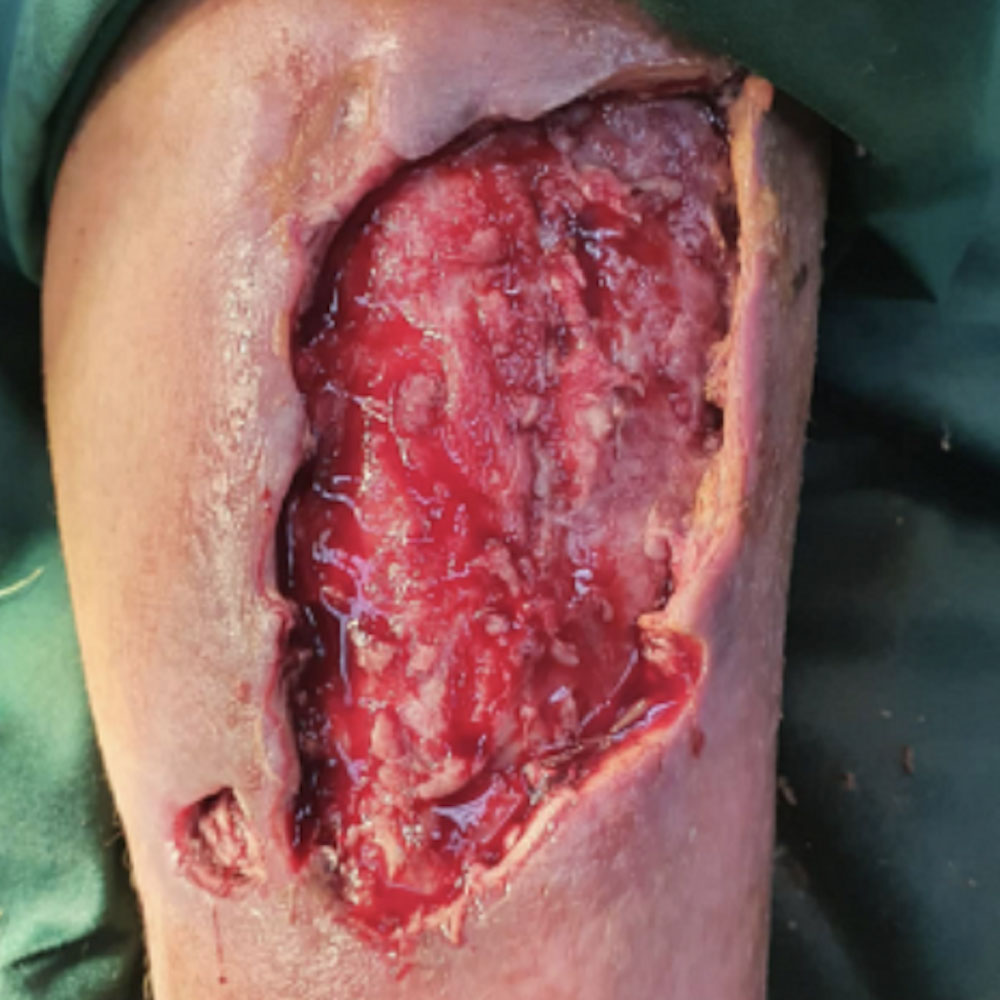 Diabetic Foot Leg Ulcer in a Hemodialysis Patient before image