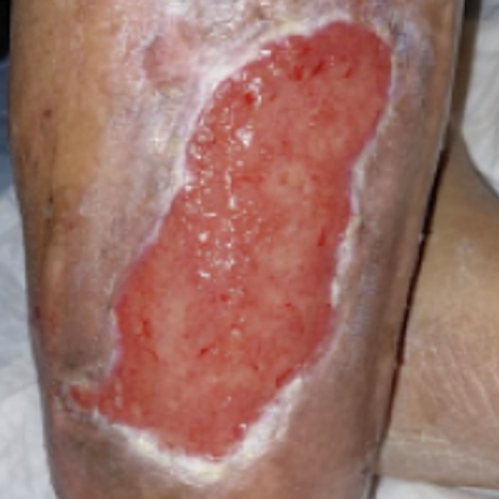 Diabetic Foot Leg Ulcer in a Hemodialysis Patient procedure image