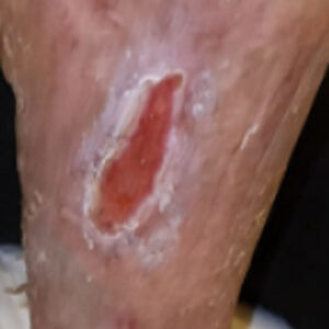 Diabetic Foot Leg Ulcer in a Hemodialysis Patient outcome image
