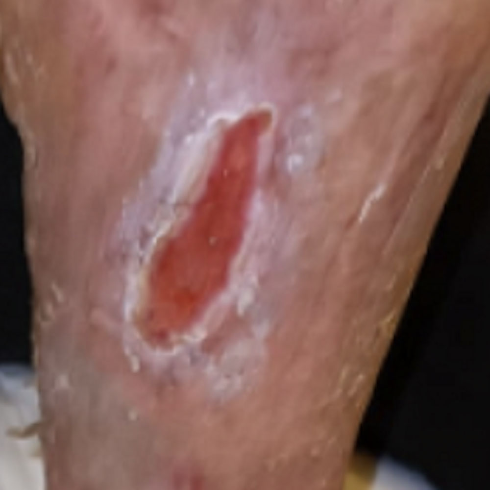 Diabetic Foot Leg Ulcer in a Hemodialysis Patient outcome image