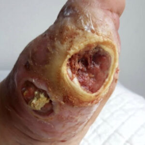 Diabetic Foot Multiple Plantar Sinus Tracts With Complete Bone Preservation before image
