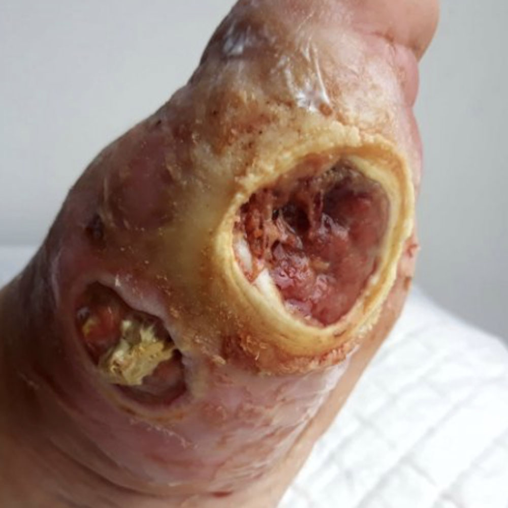 Diabetic Foot Multiple Plantar Sinus Tracts With Complete Bone Preservation before image