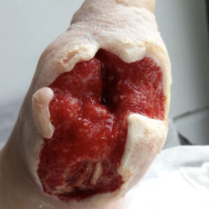 Diabetic Foot Multiple Plantar Sinus Tracts With Complete Bone Preservation procedure image