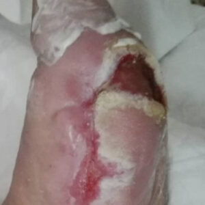 Diabetic Foot Multiple Plantar Sinus Tracts With Complete Bone Preservation outcome image