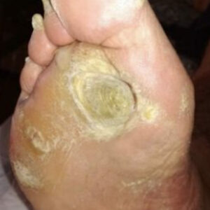 Diabetic Foot Neuropathic Plantar Ulcer before image