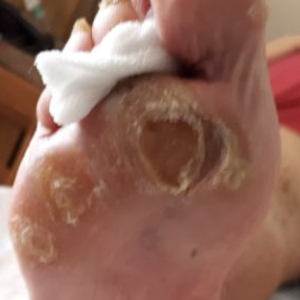 Diabetic Foot Neuropathic Plantar Ulcer procedure image